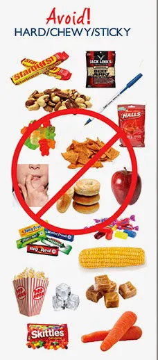 Foods to avoid with braces: hard, chewy, and sticky snacks like popcorn, nuts, hard candy, gum, caramel, and corn on the cob.