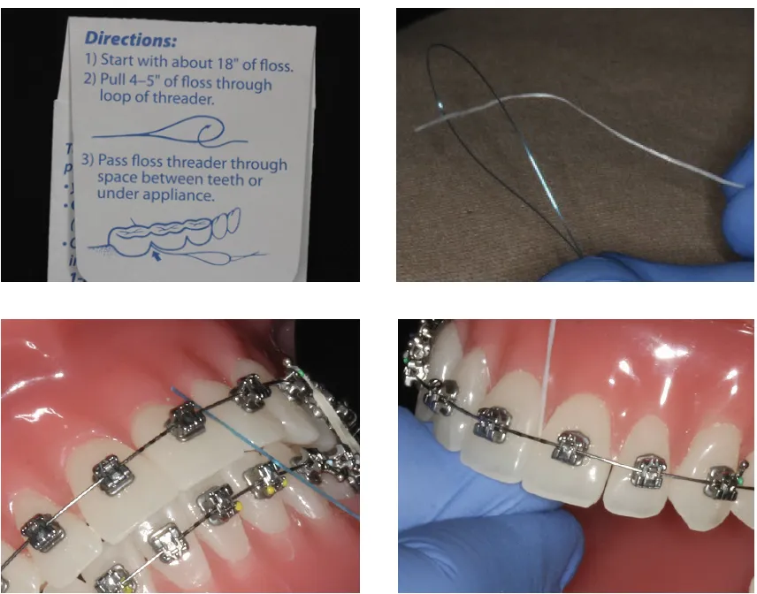 Flossing with braces using a floss threader to reach beneath the wire.