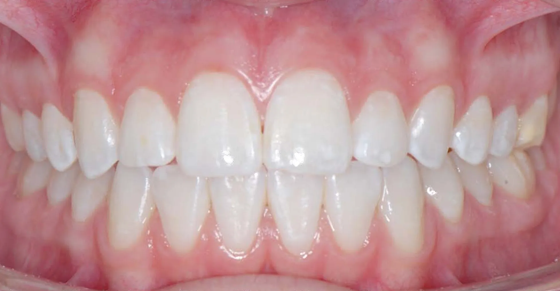 Front view of the teeth biting together with the cheeks retracted.