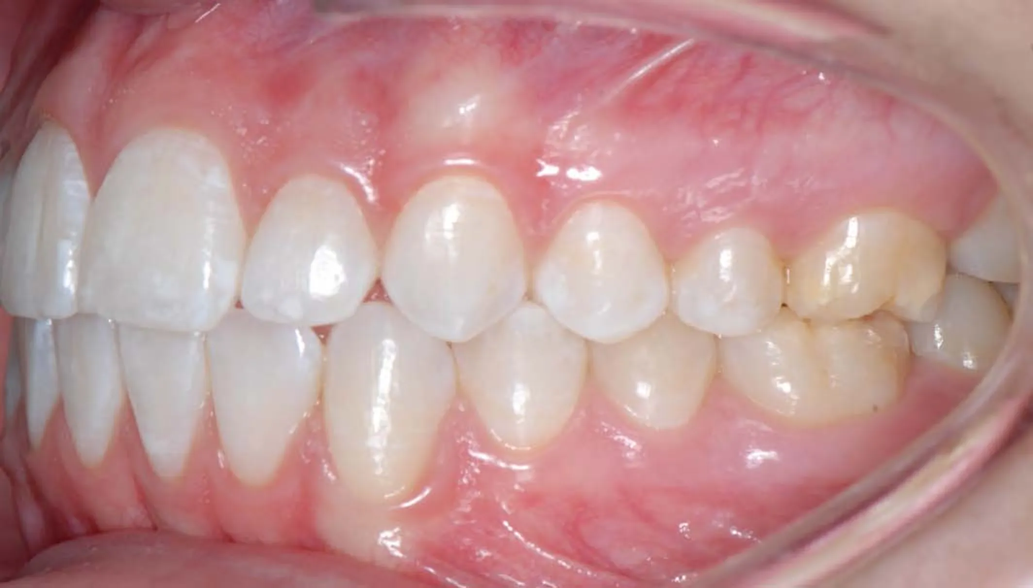 Left-side view of the teeth biting together with the cheeks retracted.